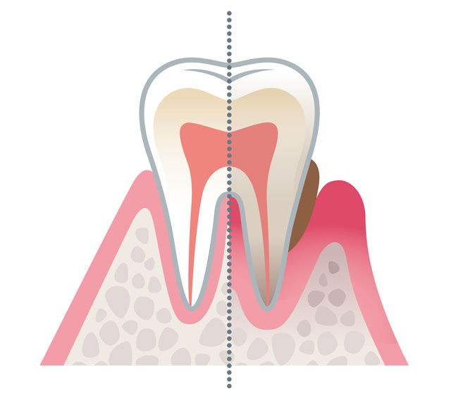 歯周病の診断