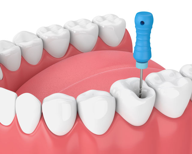 歯の根管治療